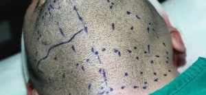 Trasplante de pelo de barba a cabeza