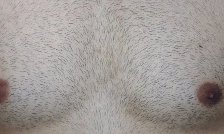 body hair transplant to head