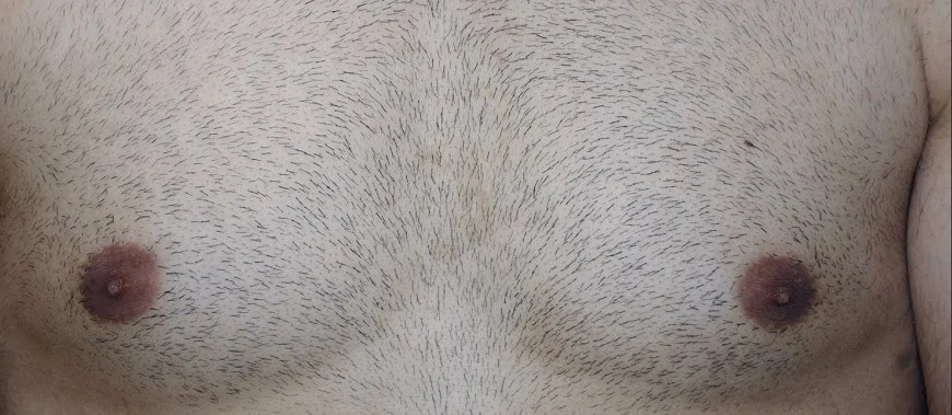 body hair transplant to head