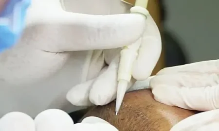 dhi transplante capilar