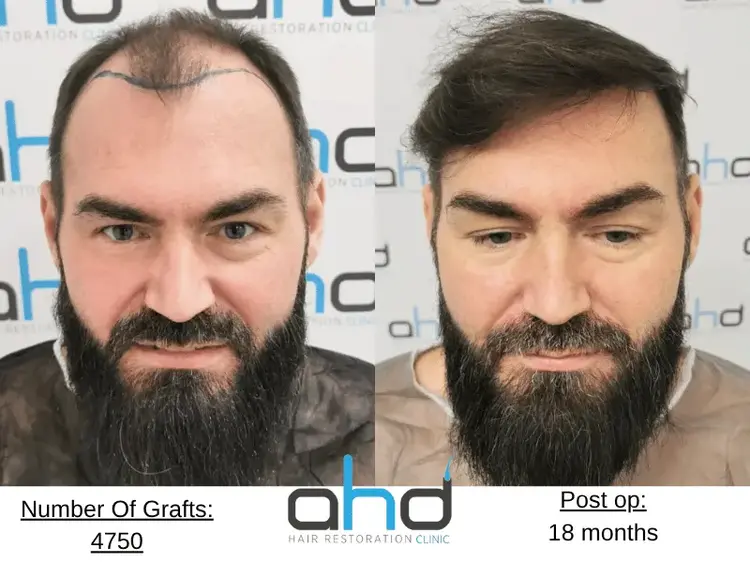 An excellent hair transplantation outcome (before and after) performed using the DHI method.