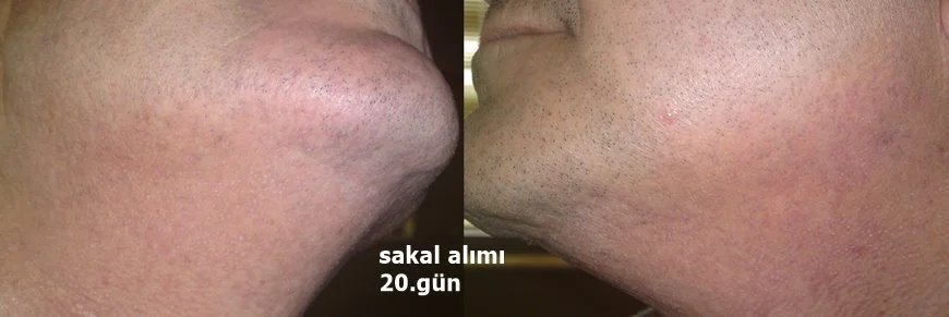 hair transplant from beard
