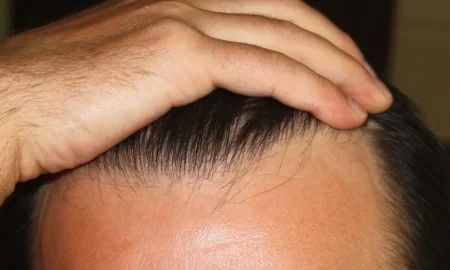 hair transplant result