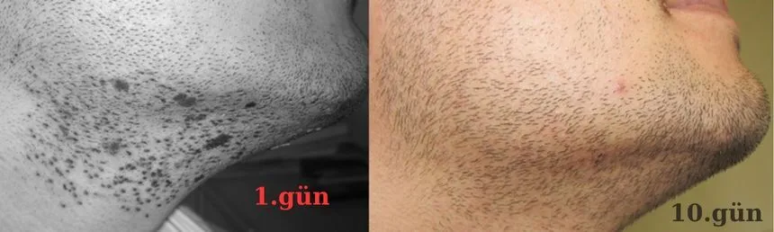 sakal bölgesinden greft alımından 10 gün sonra. İz görülmüyor.