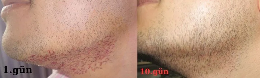 donör bölgeden sakal kılları alındı. 1 ve 10 gün görüntüsünü kıyaslayın.