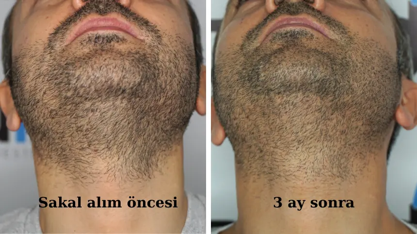 sakaldan greft alımı öncesi ve 3 ay sonraki yüz görüntüsü. iz yok