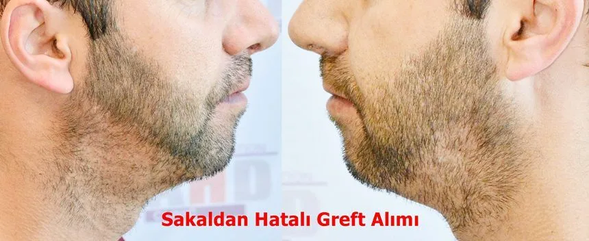 sakaldan hatalı greft alımıyla oluşan kötü görüntü