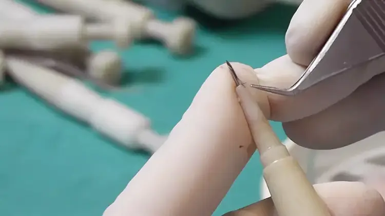 في طريقة داي، فتح القناة وزراعة الشعر يتمان في وقت واحد