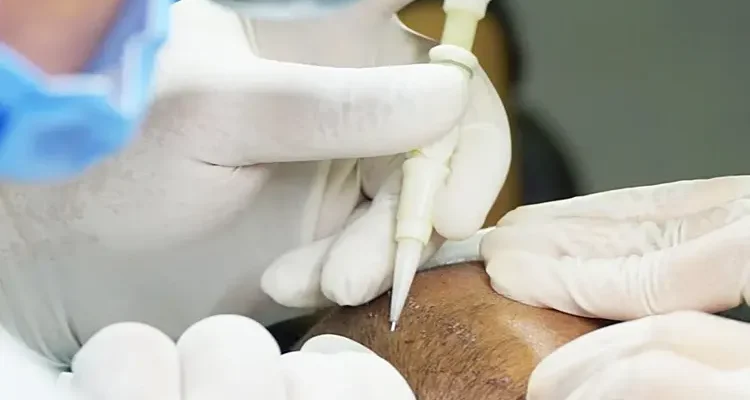 زراعة الشعر بتقنية DHI