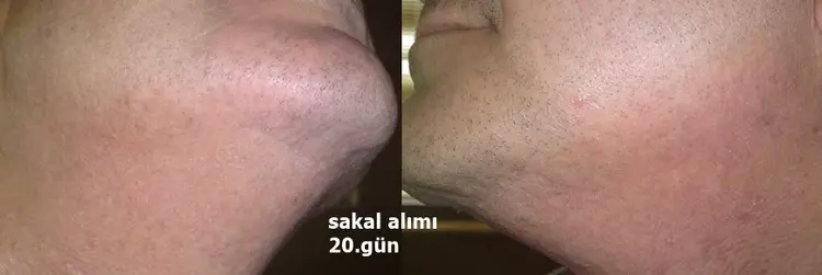 زراعة الشعر من اللحية اليوم العاشر في منطقة المتبرع

