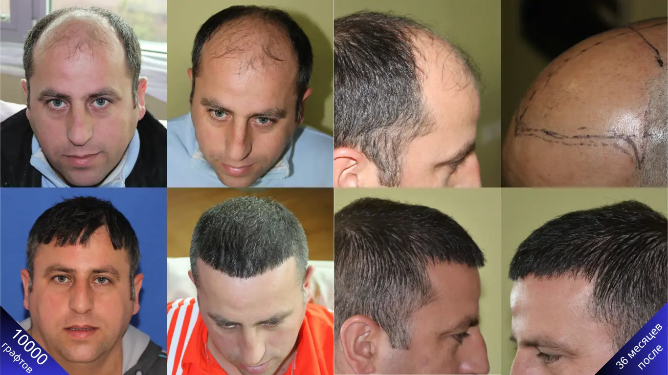 Потрясающее фото до и после пересадки 10 000 волосяных графтов