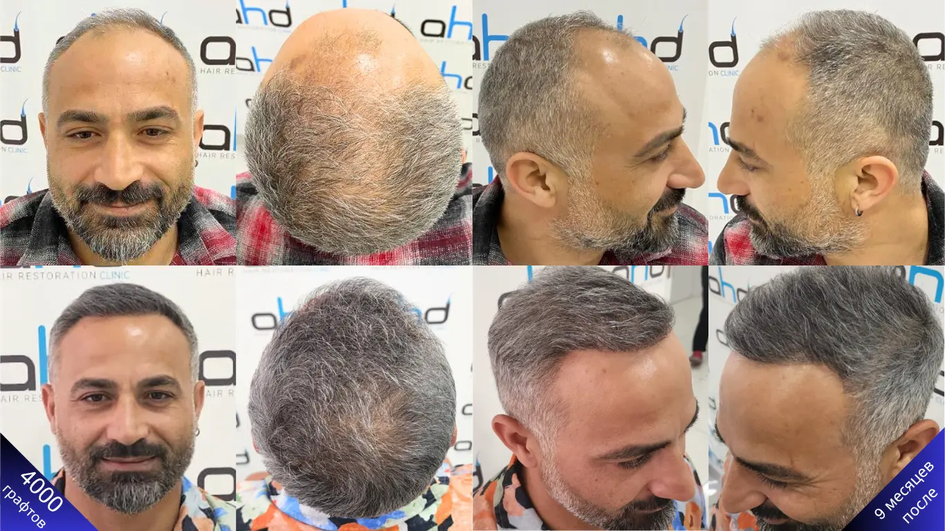 Результат пересадки 4000 графтов волос