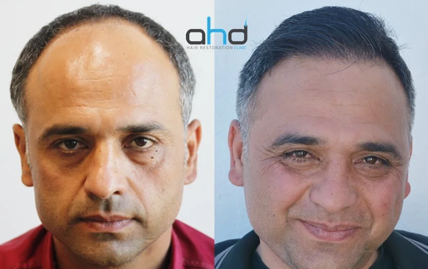 пересадка волос до и после