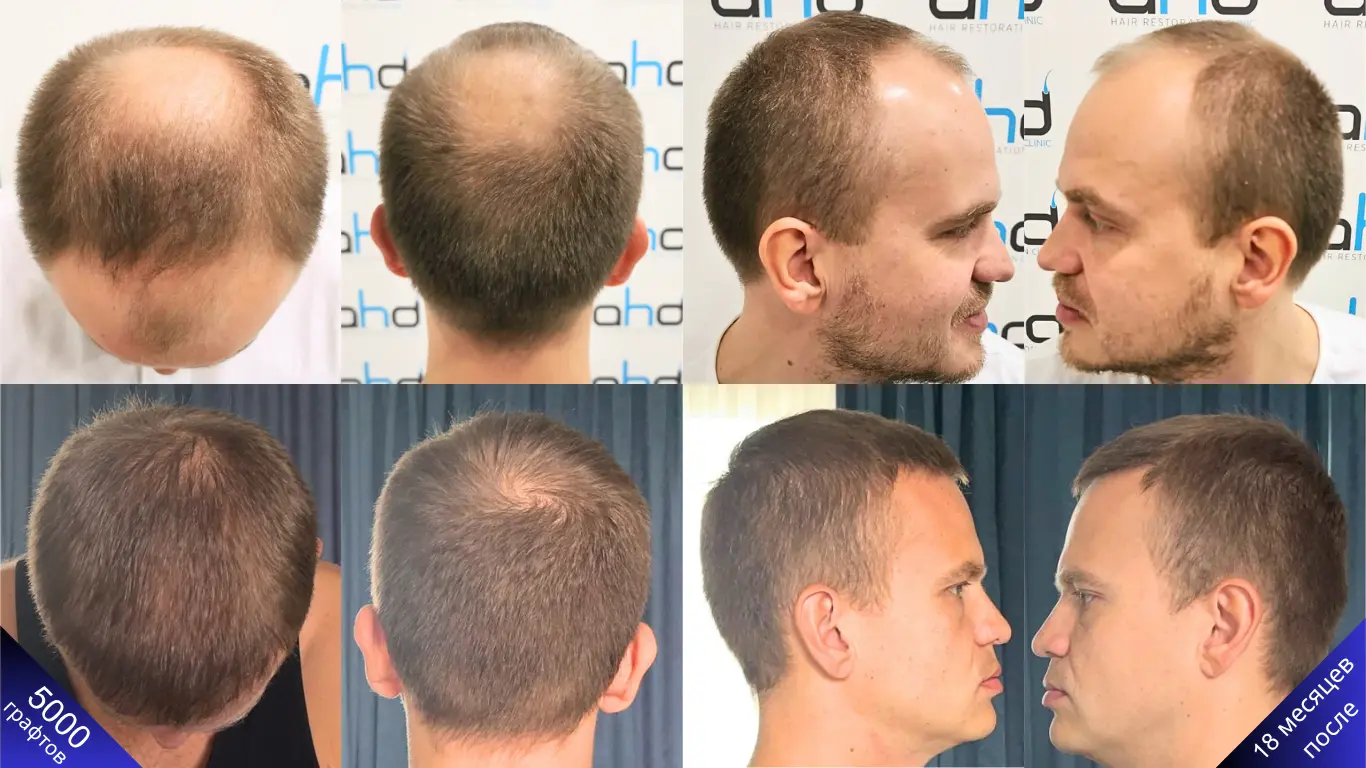 Потрясающие изменения через 18 месяцев после пересадки 5000 графтов волос