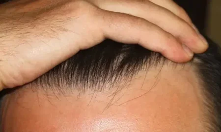 пересадка волос результаты