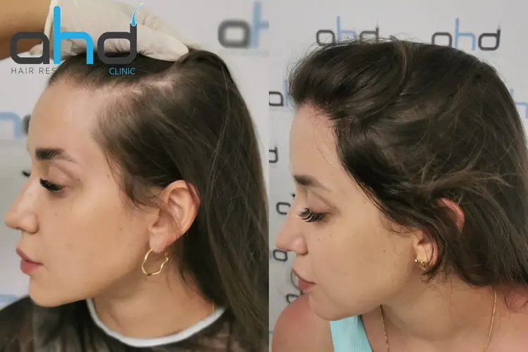 трансплантация волос женщине