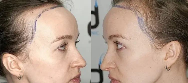 трансплантация-_волос-женщинам