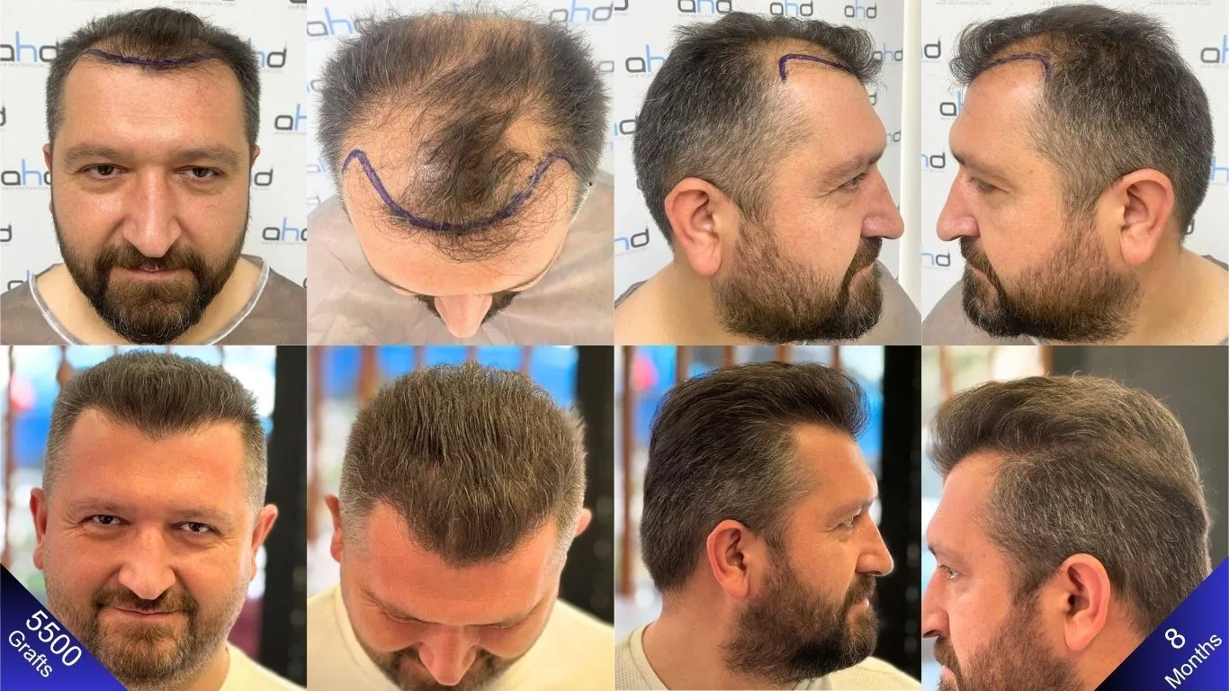 كيف تتم عملية زراعة الشعر الطبيعي والكثيف؟