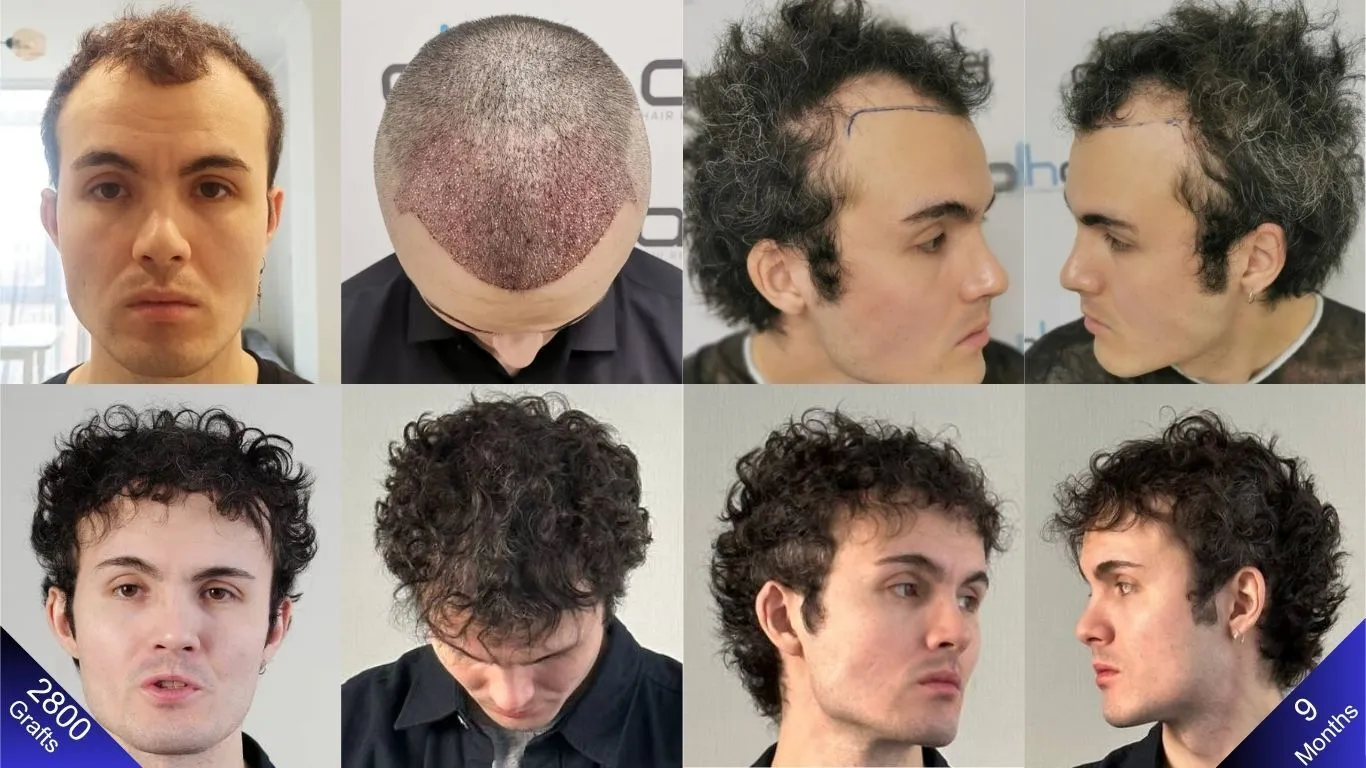 المظهر الطبيعي للرجل قبل و بعد تسعة أشهر من زراعة ٢٨٠٠ طعمة