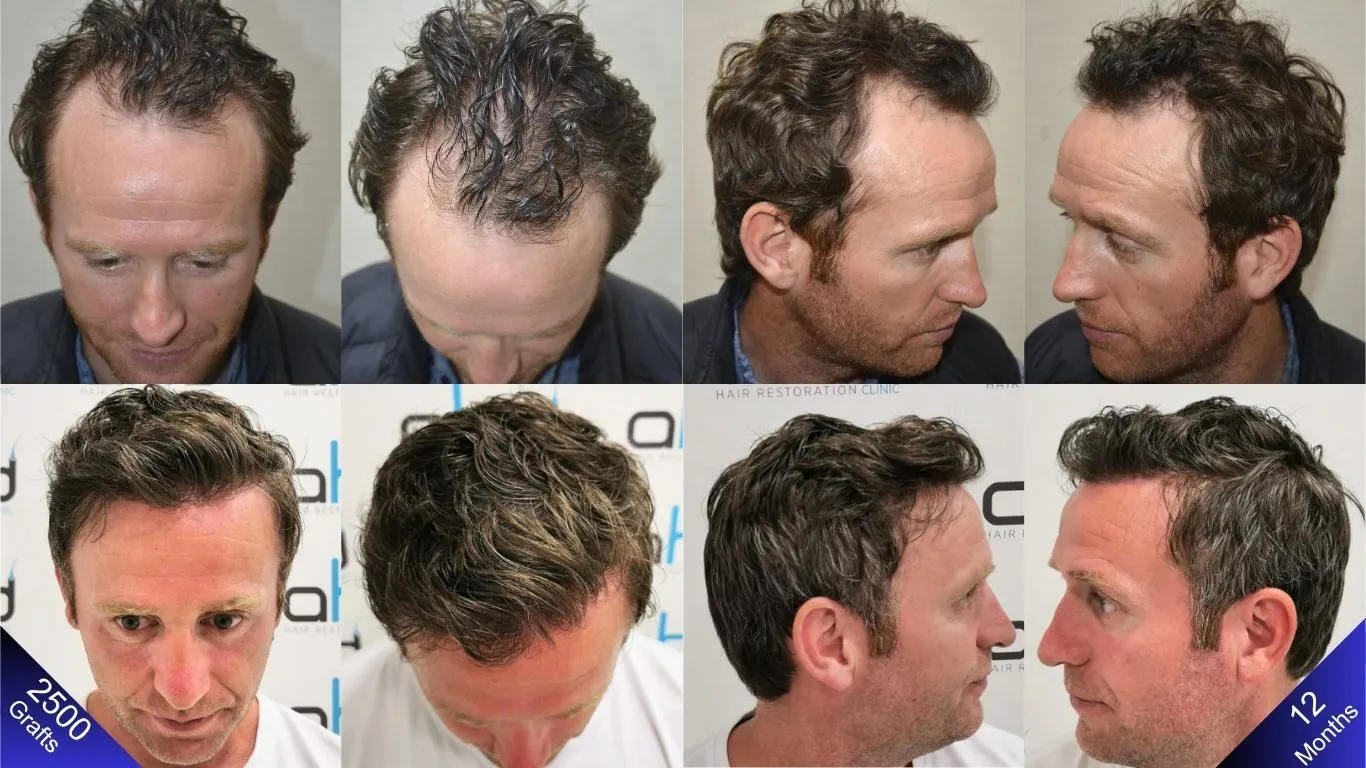 النتائج السعيدة للمريض الذي حصل على مظهر طبيعي بعد زراعة الشعر.