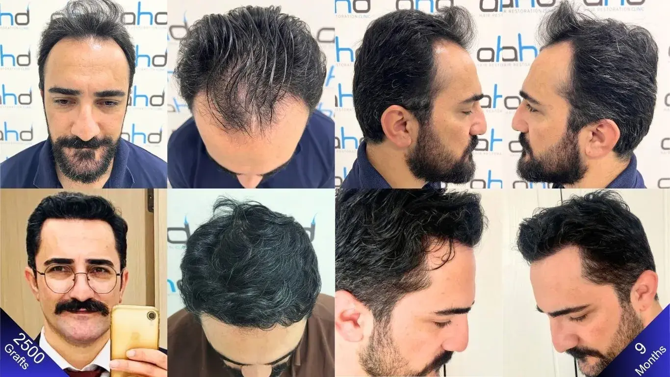 النتيجة مبهجة بعد تسعة أشهر من زراعة الشعر.