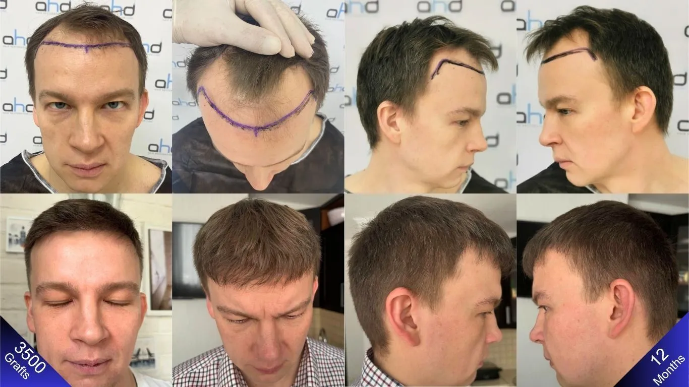 انظر النتائج مقارنة قبل زراعة الشعر وبعد سنة واحدة تظهر الفرق في كل جانب