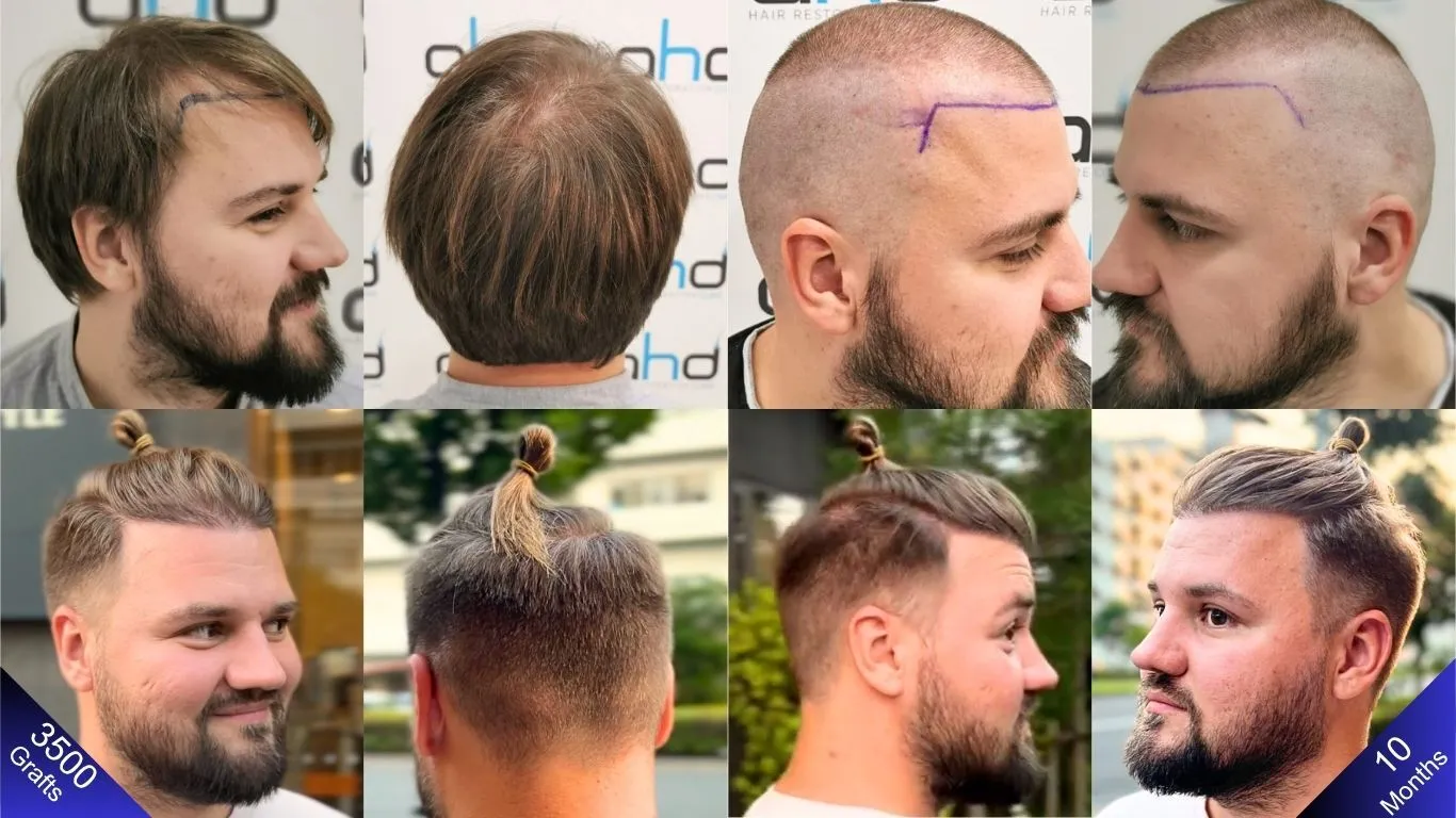 نتيجة رائعة لزراعة الشعر بـ ٣٥٠٠ طعمة
