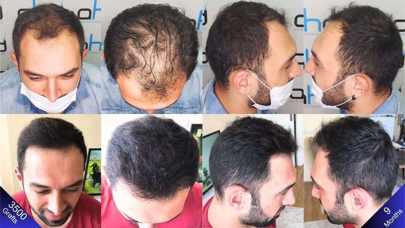 الفحص التغيير قبل و بعد تسعة أشهر من زراعة الشعر.