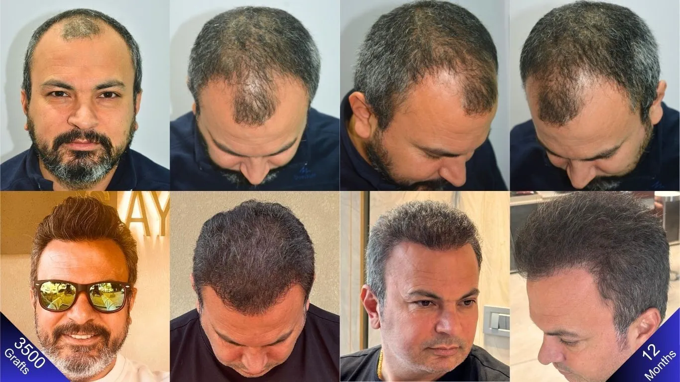 نتيجة زراعة 3500 طعمة شعرية