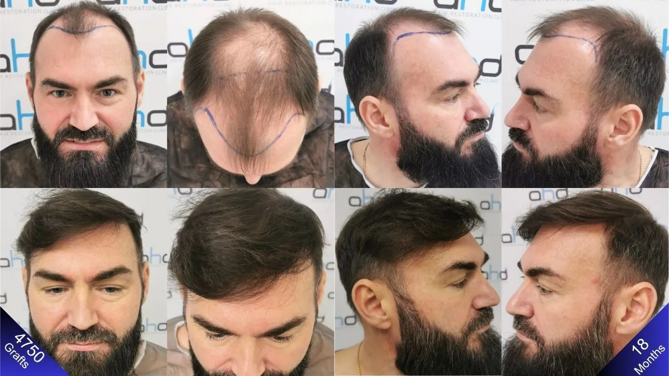 كيف كان شكله قبل زراعة الشعر؟ وأي نتيجة حقق بعد ١٨ شهرا؟ الجواب هنا.
