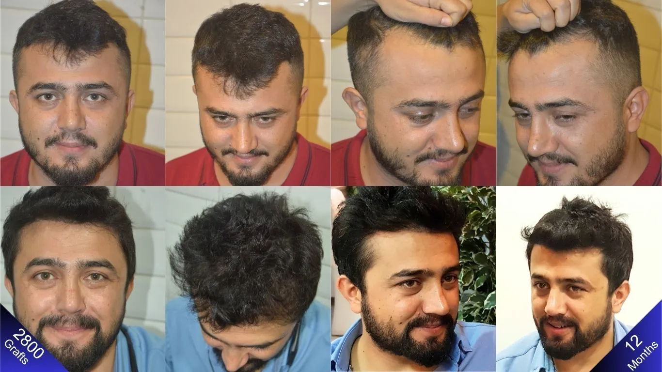 سنة من التغيير في الرجل الذي خضع لعمليات زراعة شعر وراء ولحية في وقت واحد.
