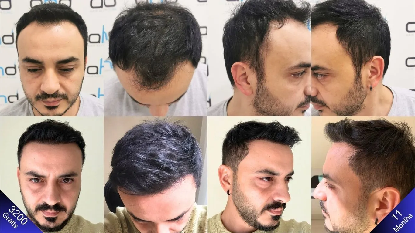 النتيجة المذهلة المحققة بعد أحد عشر شهرا من زراعة الشعر بثلاثة آلاف ومائتي طعمة.