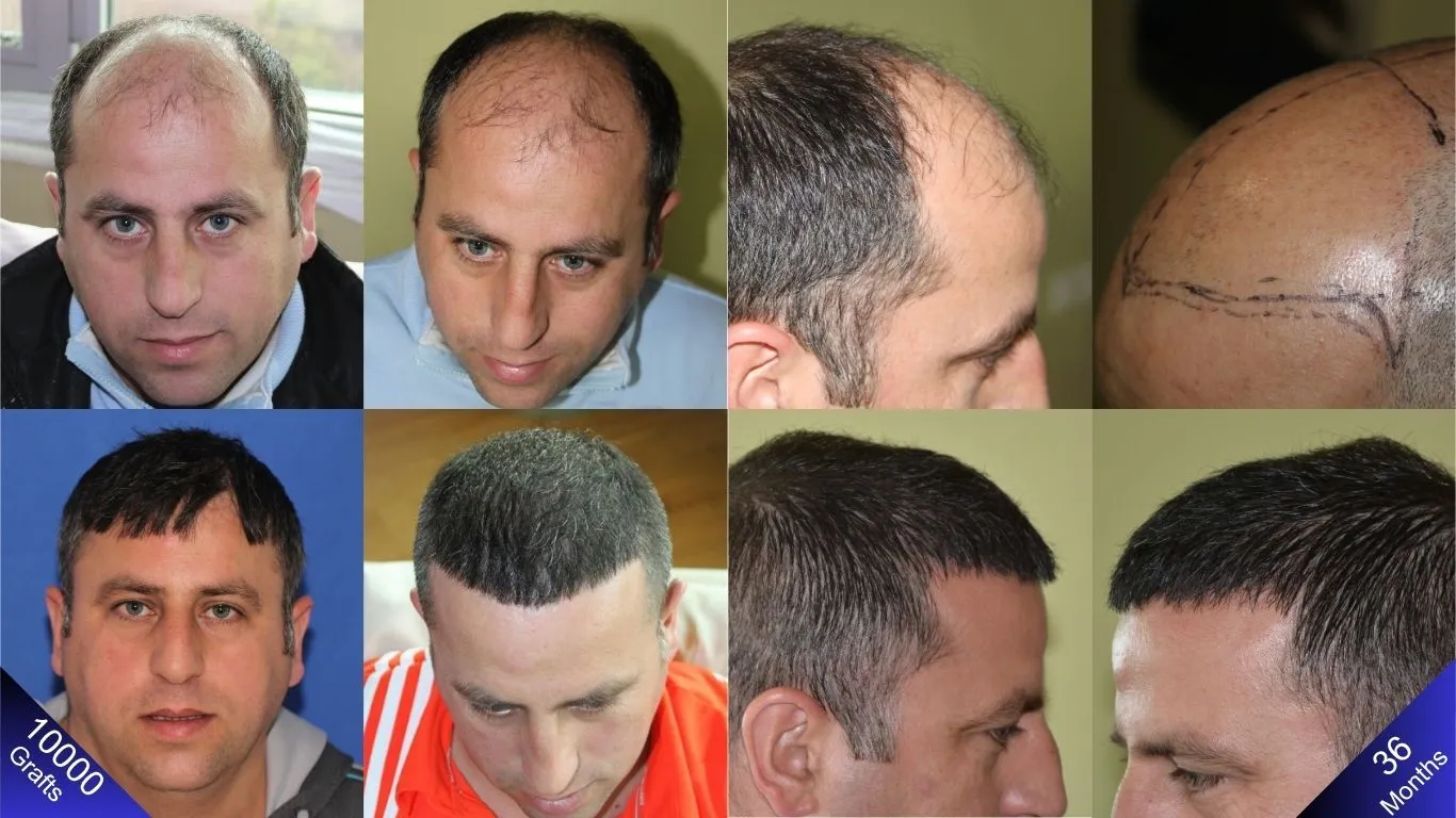 المريض نوروود 6 خضع لتحول مذهل مع زراعة 10000 طعمة شعر