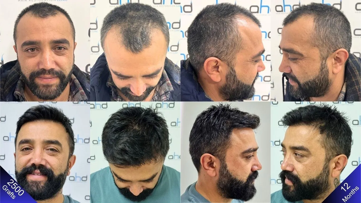 النتائج قبل وبعد لرجل خضع لزراعة ٢٥٠٠ طعمة شعرية