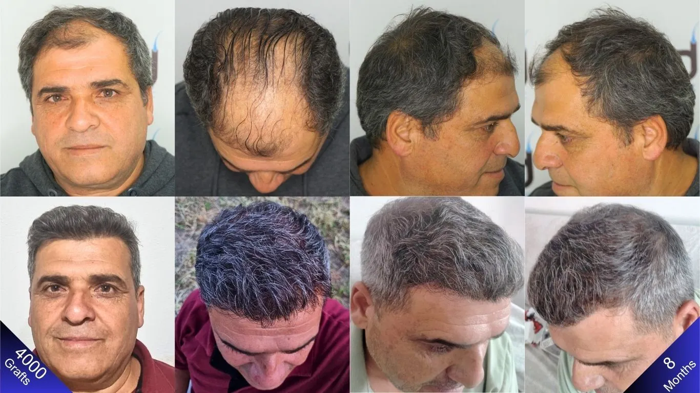 رجل أجرى زراعة شعر بـ ٤٠٠٠ طعمة، يظهر من الأمام والأعلى واليمين واليسار، بنتائج مذهلة قبل وبعد.

