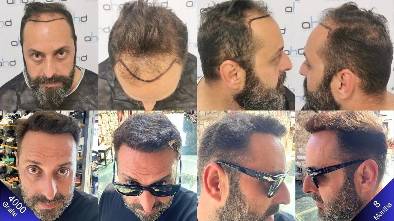 النتائج المذهلة لزراعة الشعر بـ ٤٠٠٠ طعمة