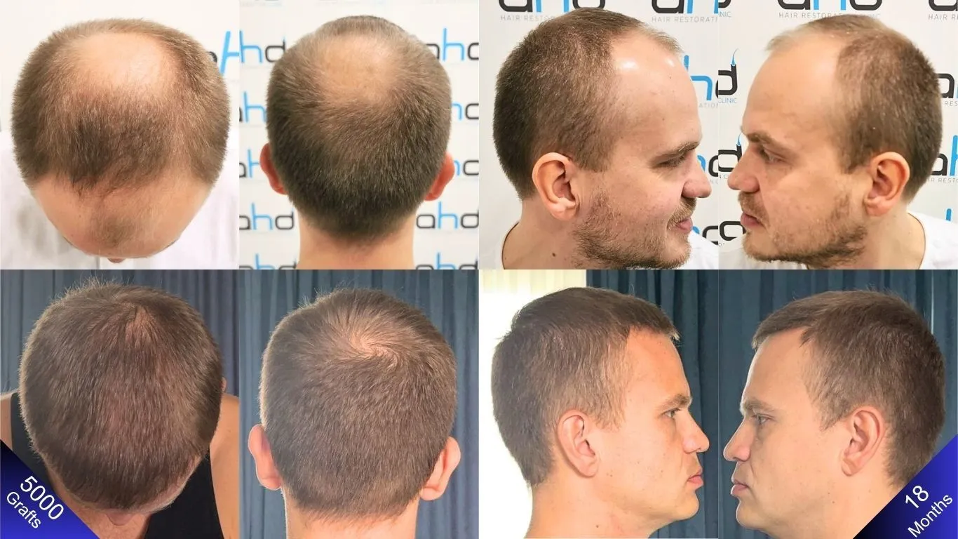 نتيجة زراعة شعر رائعة: مظهر طبيعي وكثيف