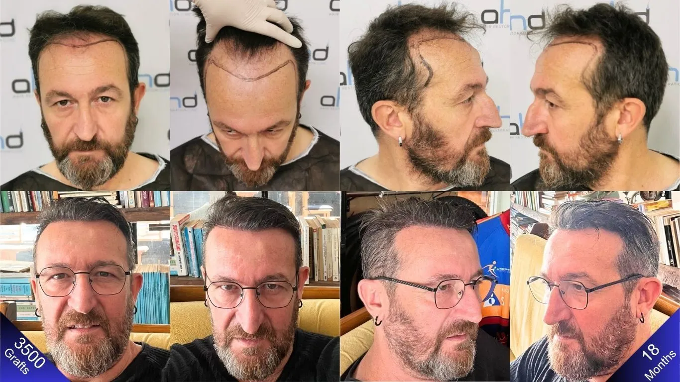أتتساءل كيف يمكن لزراعة الشعر أن تبدو طبيعية؟ انظر فقط إلى الرجل في هذه الصورة.