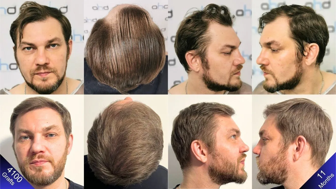التغيير قبل وبعد ١١ شهر من زراعة شعر بـ ٤١٠٠ طعمة