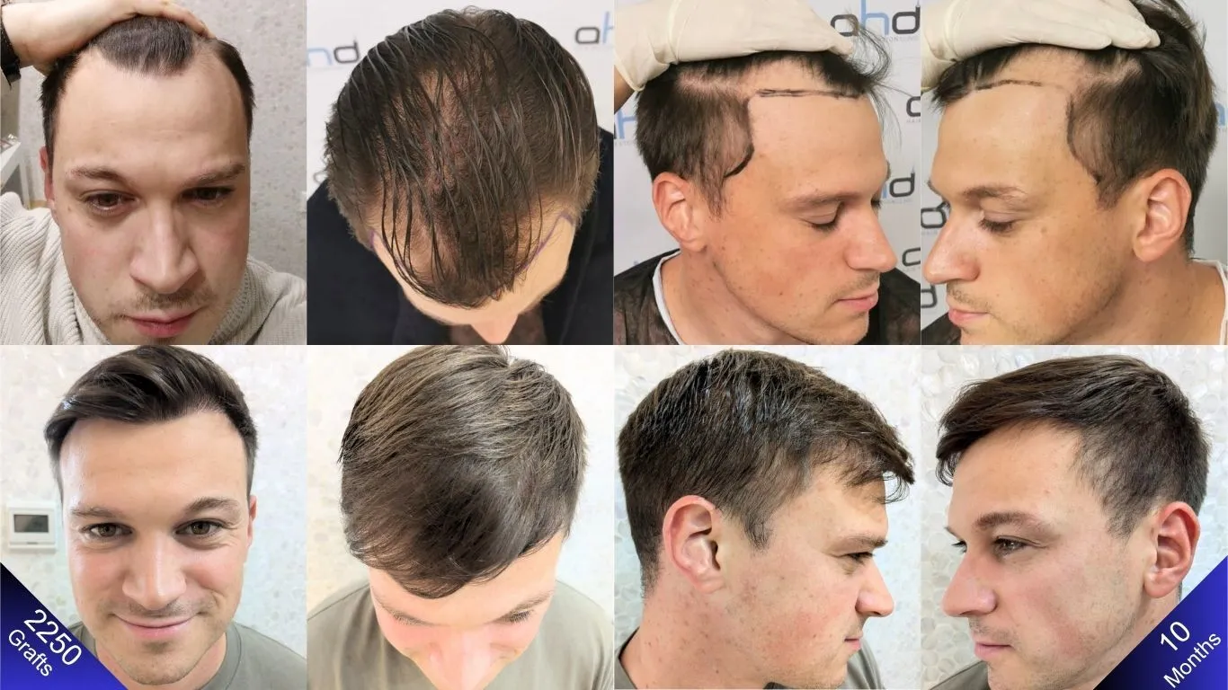 نقارن بين الصور قبل وبعد عملية زراعة الشعر لرجل
