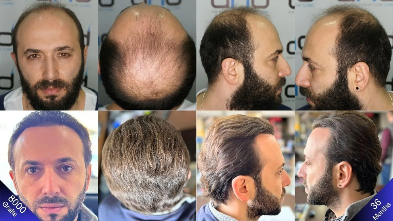 نتيجة سعيدة تحققت بزراعة ٨٠٠٠ طعمة شعر. (قارن المناظر من اليمين واليسار والأعلى والأمام).