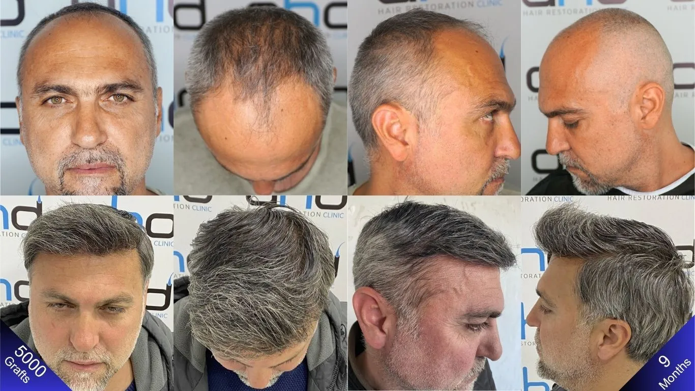 إليكم الصور الأولى والنتائج المذهلة بعد 9 أشهر لرجل خضع لزراعة 5000 طعمة شعر في تركيا.