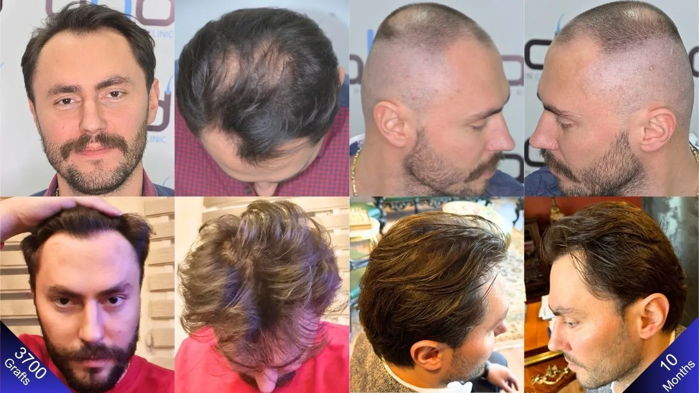 صورة رائعة قبل وبعد للرجل، بعد عشرة أشهر من زراعة شعر بـ ٣٧٠٠ طعمة.
