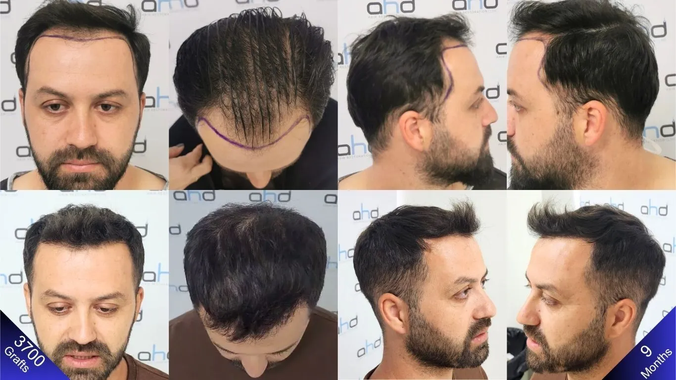 الصور قبل وبعد تظهر نتائج عملية زراعة شعر بـ ٣٧٠٠ طعمة، موضحة الجانب الأيمن والجانب الأيسر ومنطقة التاج والمنطقة الأمامية.