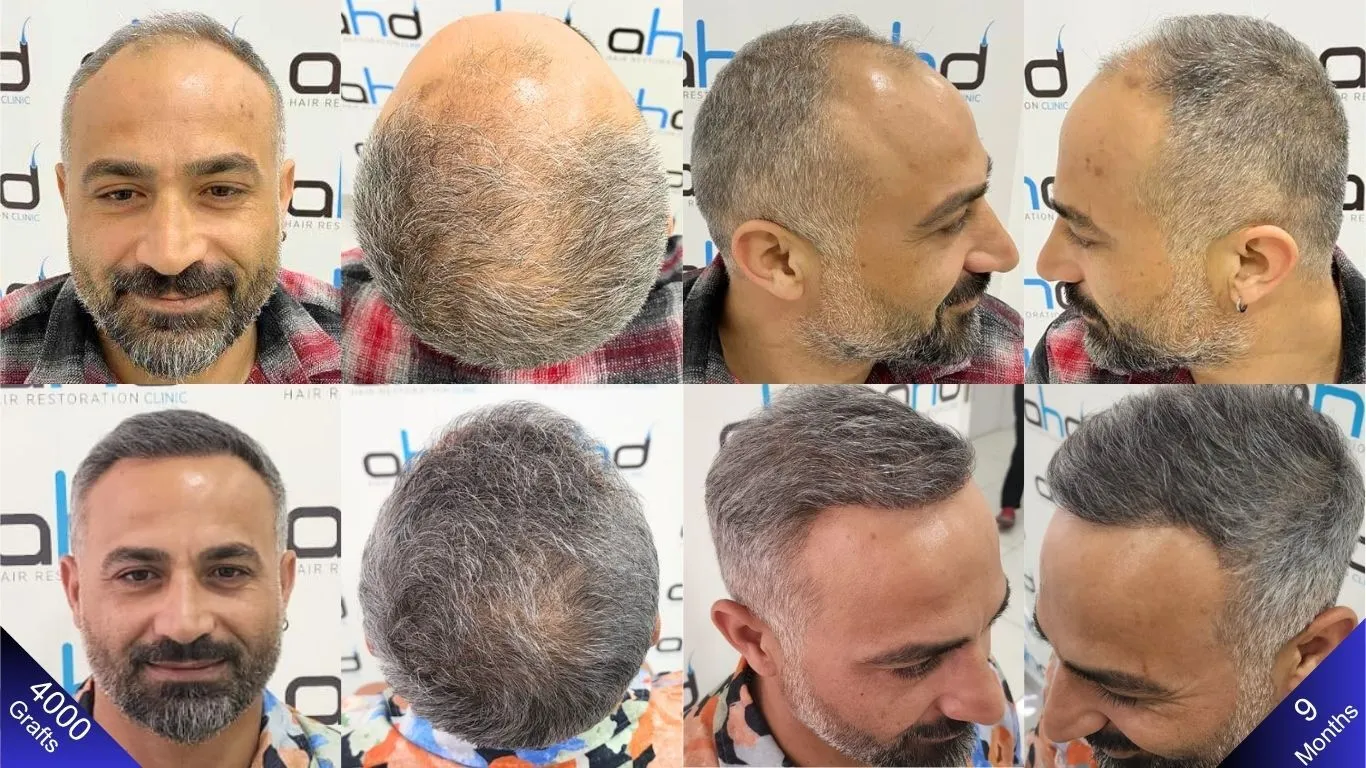 الصور تظهر قبل و بعد تسعة اشهر من زراعة الشعر التي أجريت في تركيا