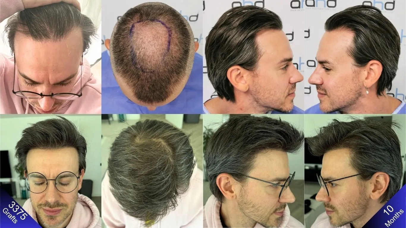 تم تحقيق نتيجة زراعة الشعر الكثيفة والمظهر الطبيعي باستخدام 3375 طعماً.