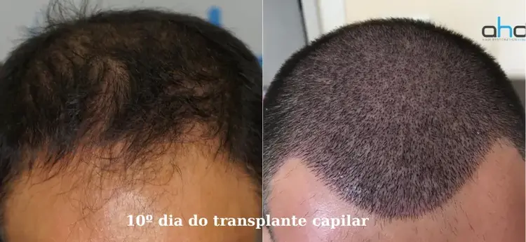 Aspecto de 10 dias após o transplante capilar