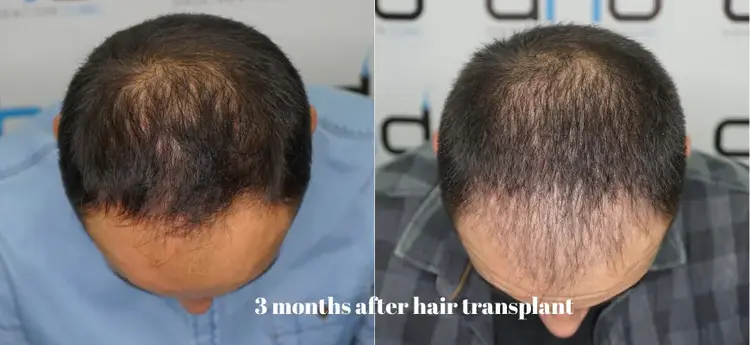 3 months hair transplant