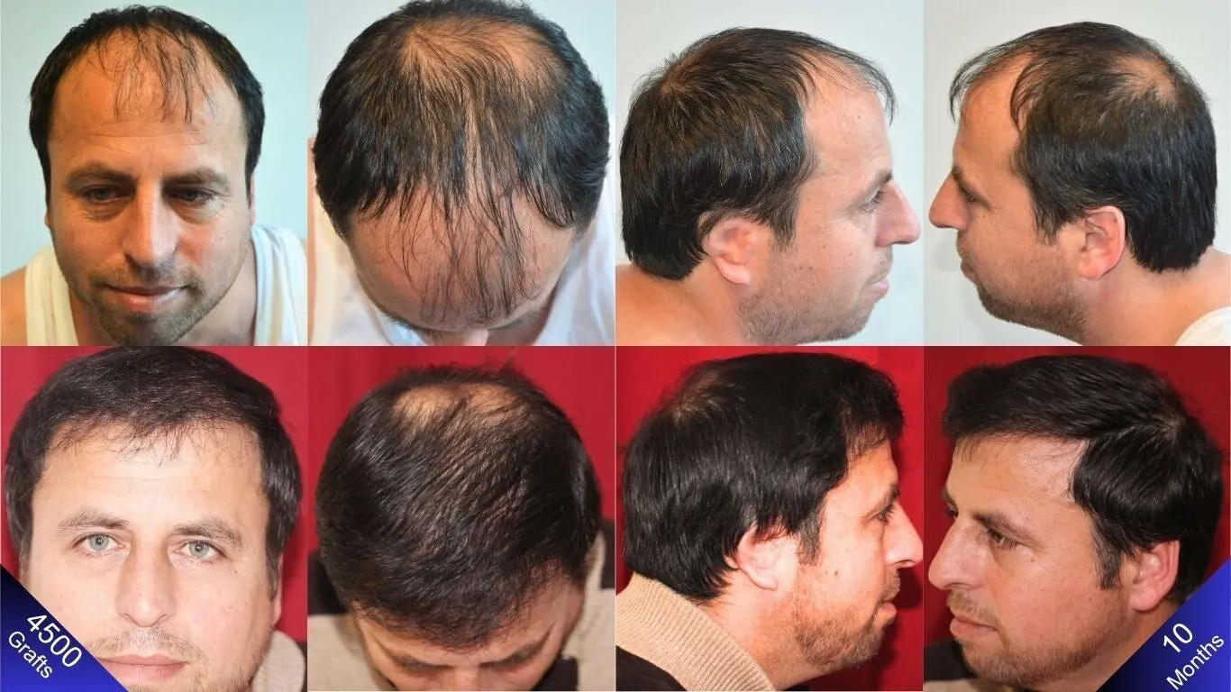 النتيجة الطبيعية للرجل الذي يظهر الفرح على وجهه بعد زراعة الشعر.