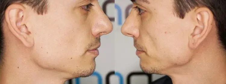 A hair transplant can be performed on a man who has no beard at all